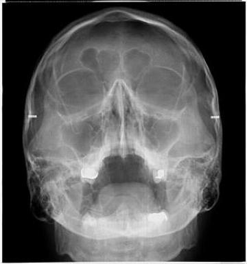 Radiografie de sinusuri anterioare ale fetei (SAF)