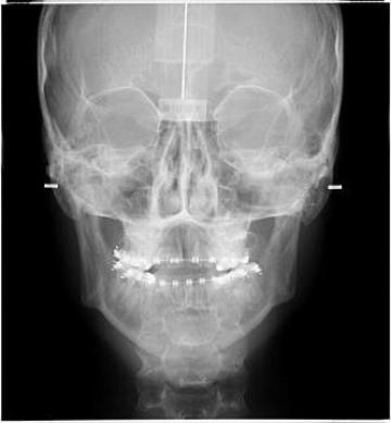 Radiografie de craniu frontal (PA/AP) de la Petra Laboratory - Centrul De Radiologie Digitala Stomatolog