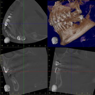 Tomografie 3D (CBCT) pentru un singur cadran 1, 2, 3 sau 4 de la Petra Laboratory - Centrul De Radiologie Digitala Stomatolog
