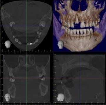 Tomografie 3D (cbct) pentru tratament endodontic