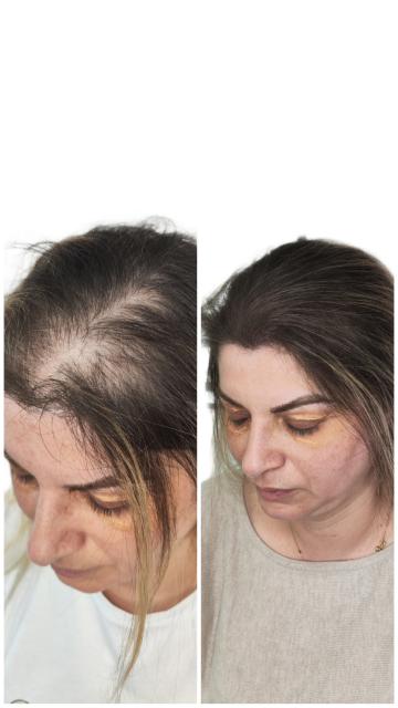 Micropigmentare scalp - efect de densitate