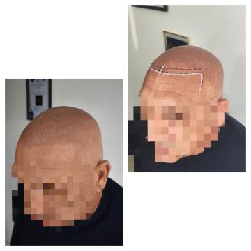 Micropigmentare scalp - efect de par ras